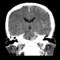Cerebral hemorrhagic contusions (Radiopaedia 23145-23188 Coronal non-contrast 23).jpg
