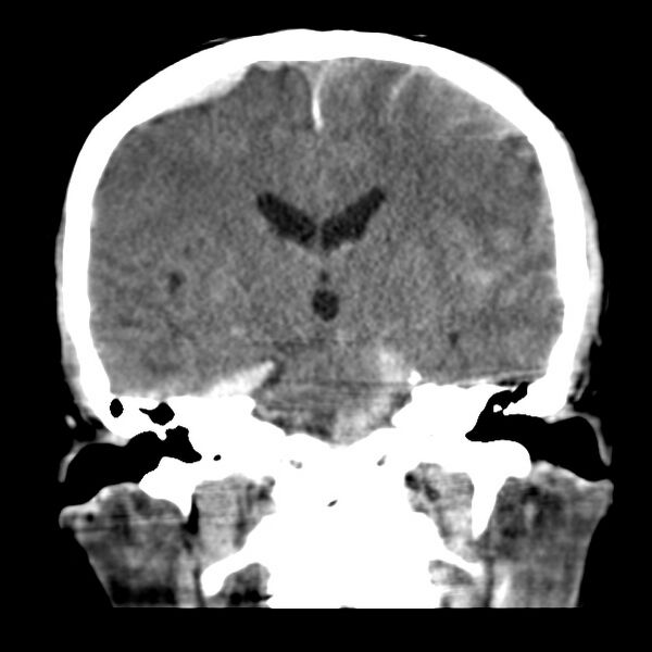 File:Cerebral hemorrhagic contusions (Radiopaedia 23145-23188 Coronal non-contrast 23).jpg