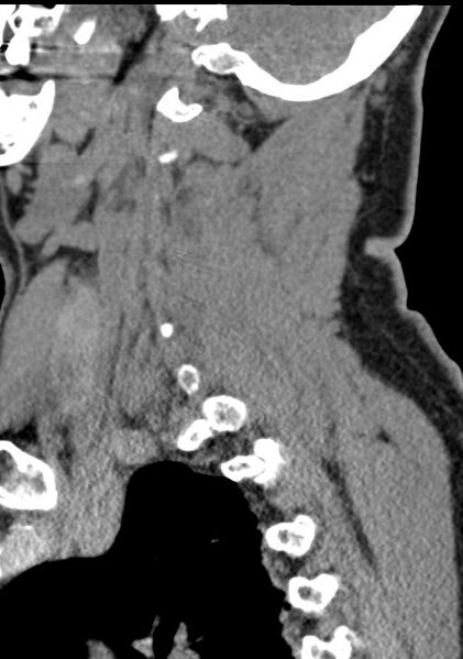 File:Cerebral hemorrhagic contusions and cervical spine fractures (Radiopaedia 32865-33841 G 81).jpg