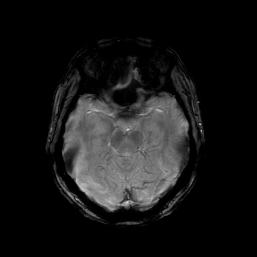 Cerebral paragonimiasis (Radiopaedia 73473-84238 Axial SWI 26).jpg
