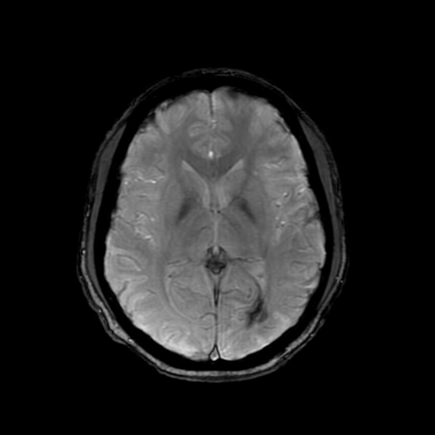 Cerebral paragonimiasis (Radiopaedia 73473-84238 Axial SWI 37).jpg