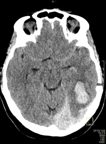 File:Cerebral venous sinus thrombosis (Radiopaedia 91329-108965 Axial non-contrast 20).jpg