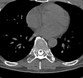 Cervical dural CSF leak on MRI and CT treated by blood patch (Radiopaedia 49748-54996 B 64).png