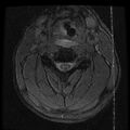 Cervical flexion teardrop fracture with cord hemorrhage (Radiopaedia 32497-33455 Axial Gradient Echo 11).jpg