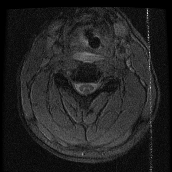 File:Cervical flexion teardrop fracture with cord hemorrhage (Radiopaedia 32497-33455 Axial Gradient Echo 11).jpg