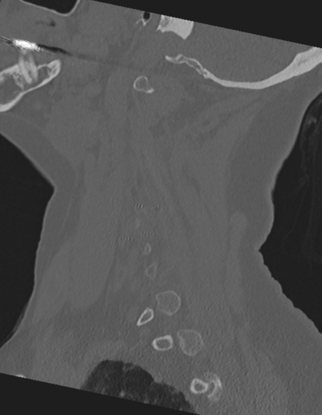 File:Cervical spine ACDF loosening (Radiopaedia 48998-54071 Sagittal bone window 24).png