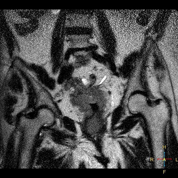 File:Cervical stump squamous cell carcinoma (Radiopaedia 48049-52858 Coronal T2 8).jpg