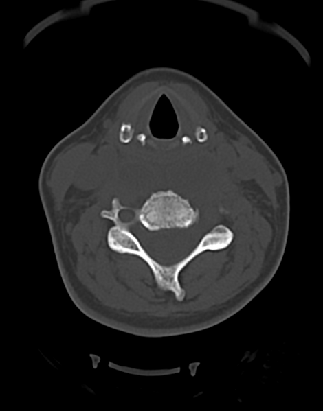File:Cervical tuberculous spondylitis (Radiopaedia 39149-41365 Axial bone window 28).png