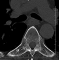 Chalk stick fracture - ankylosing spondylitis (Radiopaedia 52572-58513 Axial bone window 1).png