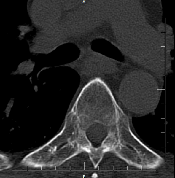 File:Chalk stick fracture - ankylosing spondylitis (Radiopaedia 52572-58513 Axial bone window 1).png