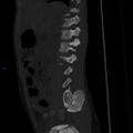 Chance fracture with duodenal and pancreatic lacerations (Radiopaedia 43477-50042 Sagittal bone window 3).jpg