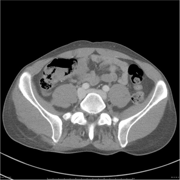 File:Chest and abdomen multi-trauma (Radiopaedia 26294-26426 A 61).jpg