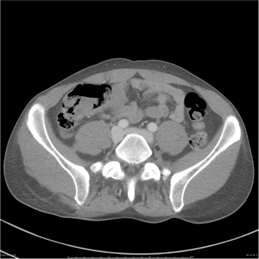 Chest and abdomen multi-trauma (Radiopaedia 26294-26426 A 61).jpg