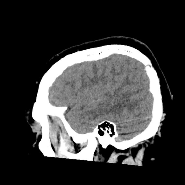File:Chiasmatic-hypothalamic juvenile pilocytic astrocytoma (Radiopaedia 78533-91237 B 49).jpg