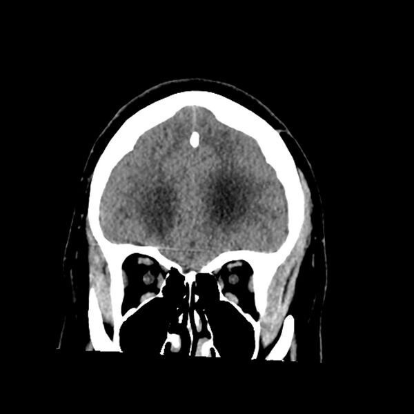 File:Chiasmatic-hypothalamic juvenile pilocytic astrocytoma (Radiopaedia 78533-91237 Coronal non-contrast 19).jpg