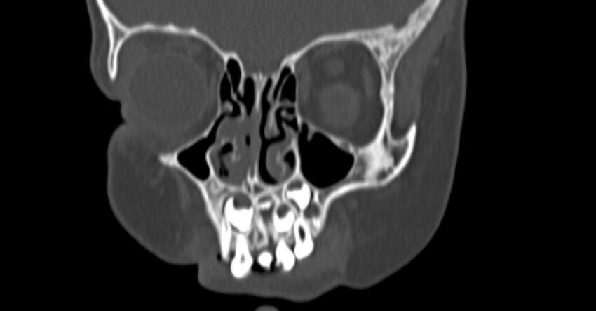 Choanal atresia (Radiopaedia 51295-56972 Coronal bone window 17).jpg