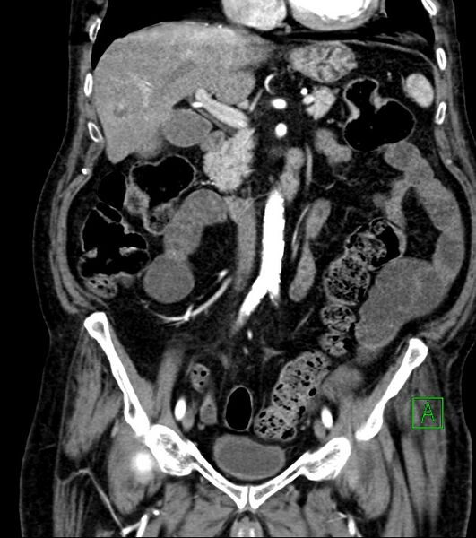 File:Cholangiocarcinoma with cerebral metastases (Radiopaedia 83519-98629 E 43).jpg