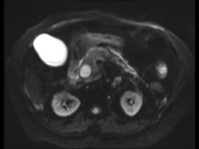 File:Choledocholithiasis causing intrahepatic biliary duct dilation (Radiopaedia 39908-42369 Axial T2 SPAIR 13).jpg