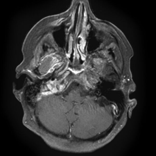File:Chondrosarcoma - occipital condyle (Radiopaedia 8969-9744 Axial T1 C+ 1).jpg