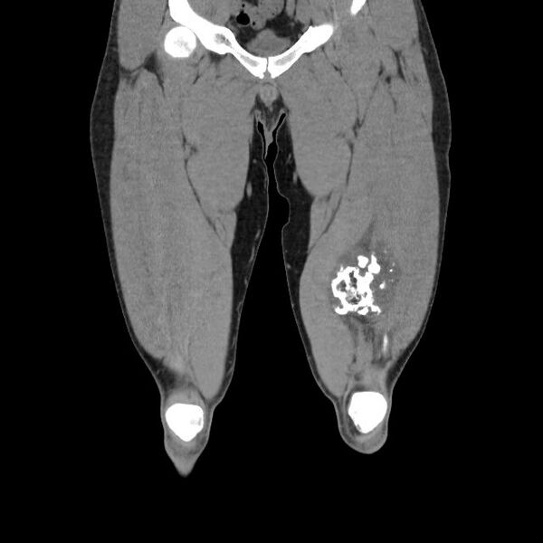 File:Chondrosarcoma arising from exostosis (Radiopaedia 59996-67507 Coronal soft tissue 8).jpg