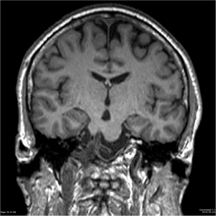 Chondrosarcoma of skull base- grade II (Radiopaedia 40948-43654 Coronal T1 13).jpg