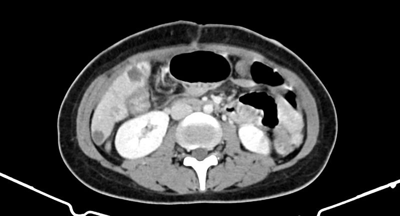 File:Choriocarcinoma liver metastases (Radiopaedia 74768-85766 A 109).jpg