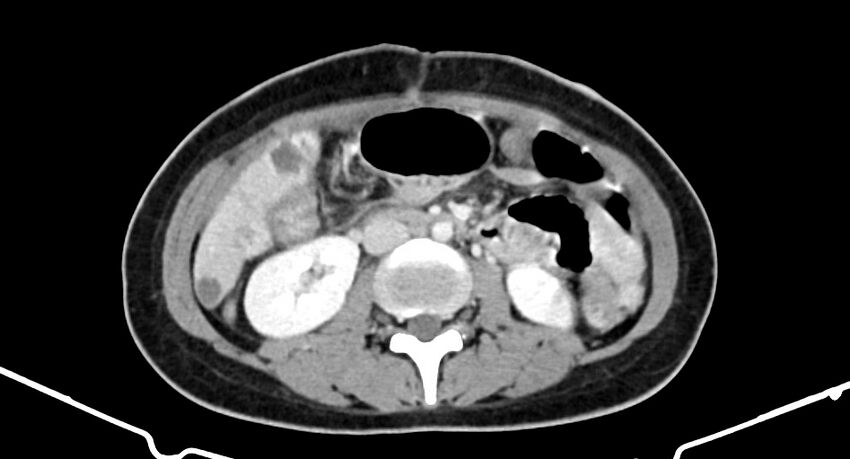 Choriocarcinoma liver metastases (Radiopaedia 74768-85766 A 109).jpg