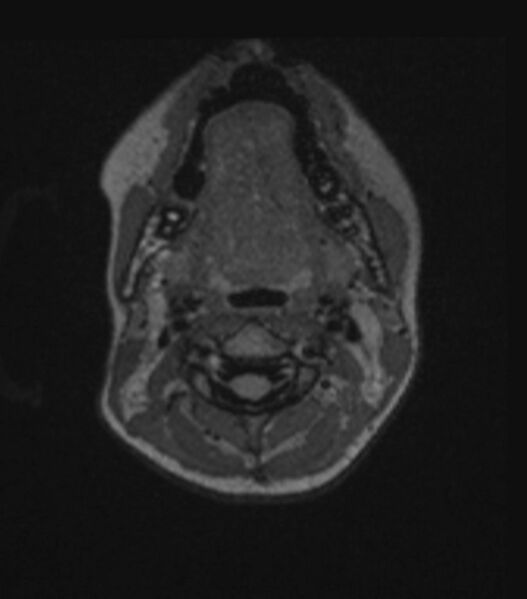 File:Choroid plexus carcinoma (Radiopaedia 91013-108553 Axial FLAIR C+ 39).jpg