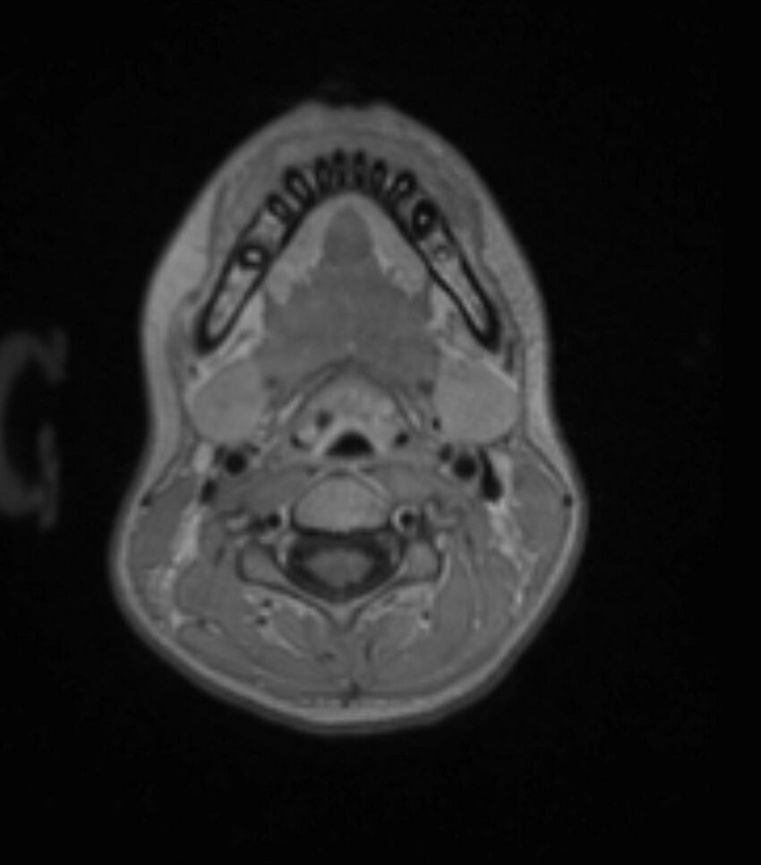 Choroid plexus carcinoma (Radiopaedia 91013-108553 Axial T1 C+ 25).jpg