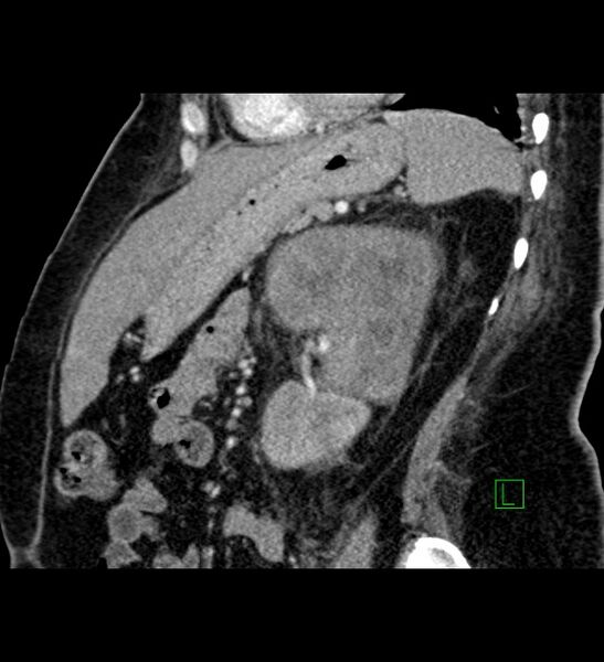 File:Chromophobe renal cell carcinoma (Radiopaedia 84239-99519 D 43).jpg