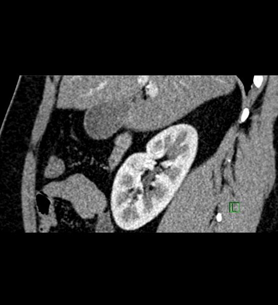 File:Chromophobe renal cell carcinoma (Radiopaedia 84286-99573 F 117).jpg