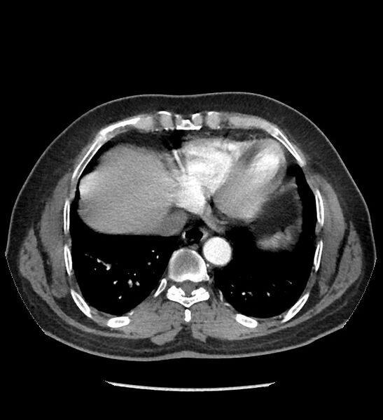 File:Chromophobe renal cell carcinoma (Radiopaedia 86879-103083 B 11).jpg