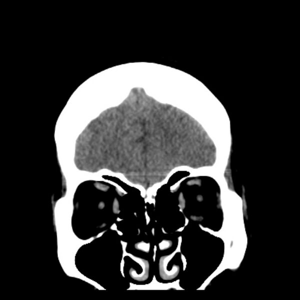 File:Chronic bilateral occipital lobe infarcts (Radiopaedia 31276-31996 Coronal non-contrast 11).jpg