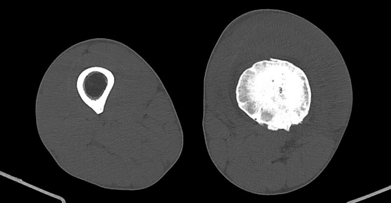 File:Chronic osteomyelitis (with sequestrum) (Radiopaedia 74813-85822 Axial non-contrast 128).jpg