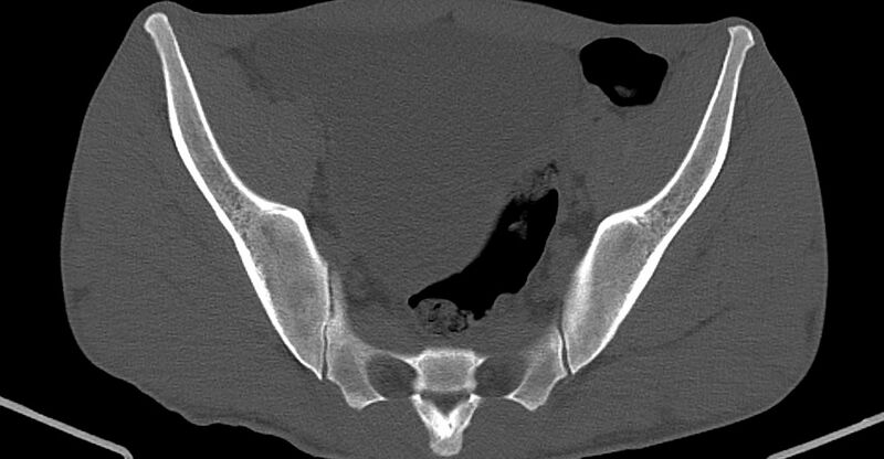 File:Chronic osteomyelitis (with sequestrum) (Radiopaedia 74813-85822 Axial non-contrast 17).jpg