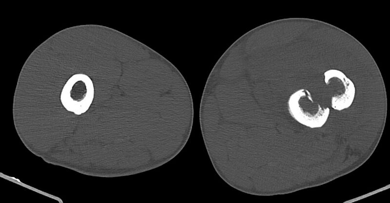 File:Chronic osteomyelitis (with sequestrum) (Radiopaedia 74813-85822 Axial non-contrast 84).jpg