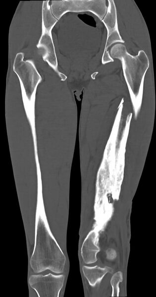 File:Chronic osteomyelitis (with sequestrum) (Radiopaedia 74813-85822 Coronal non-contrast 32).jpg