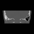 Chronic otomastoiditis (Radiopaedia 27138-27309 Coronal bone window 22).jpg