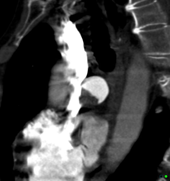 File:Chronic pulmonary embolism (Radiopaedia 17943-17702 Sagittal C+ CTPA 6).jpg