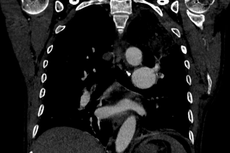 File:Chronic pulmonary embolism with bubbly consolidation (Radiopaedia 91248-108850 B 87).jpg