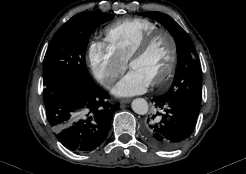 File:Chronic pulmonary embolism with bubbly consolidation (Radiopaedia 91248-108850 C+ arterial phase 104).jpg