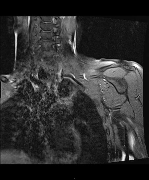 File:Chronic reactive multifocal osteomyelitis (CRMO) - clavicle (Radiopaedia 56406-63114 Coronal T1 fat sat 1).jpg
