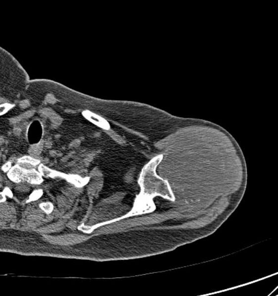 File:Clear cell chondrosarcoma - humerus (Radiopaedia 63104-71612 Axial non-contrast 26).jpg