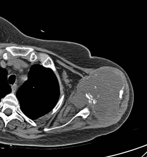 File:Clear cell chondrosarcoma - humerus (Radiopaedia 63104-71612 Axial non-contrast 43).jpg