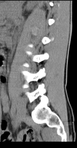 File:Clear cell meningoma - lumbar spine (Radiopaedia 60116-67691 A 14).png