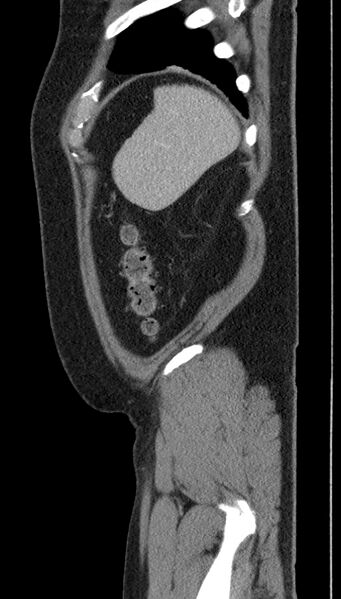 File:Clear cell renal cell carcinoma (Radiopaedia 61449-69393 G 1).jpg