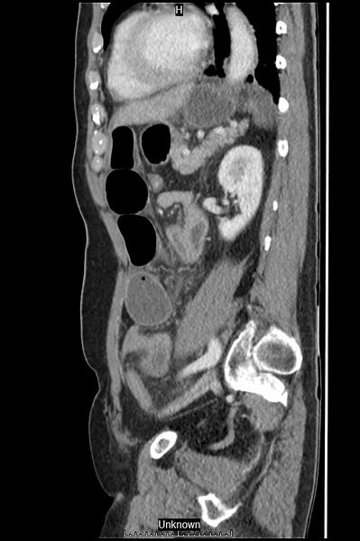 File:Closed loop bowel obstruction and ischemia (Radiopaedia 86959-103180 C 20).jpg