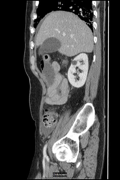 File:Closed loop bowel obstruction and ischemia (Radiopaedia 86959-103180 C 50).jpg