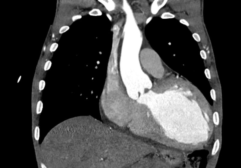 File:Coarctation of aorta with aortic valve stenosis (Radiopaedia 70463-80574 C 77).jpg