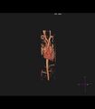 Coarctation of the aorta (Radiopaedia 43373-46729 3D reconstruction 26).jpg